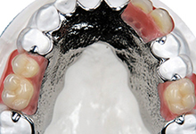 Cobolt Chrome Dentures